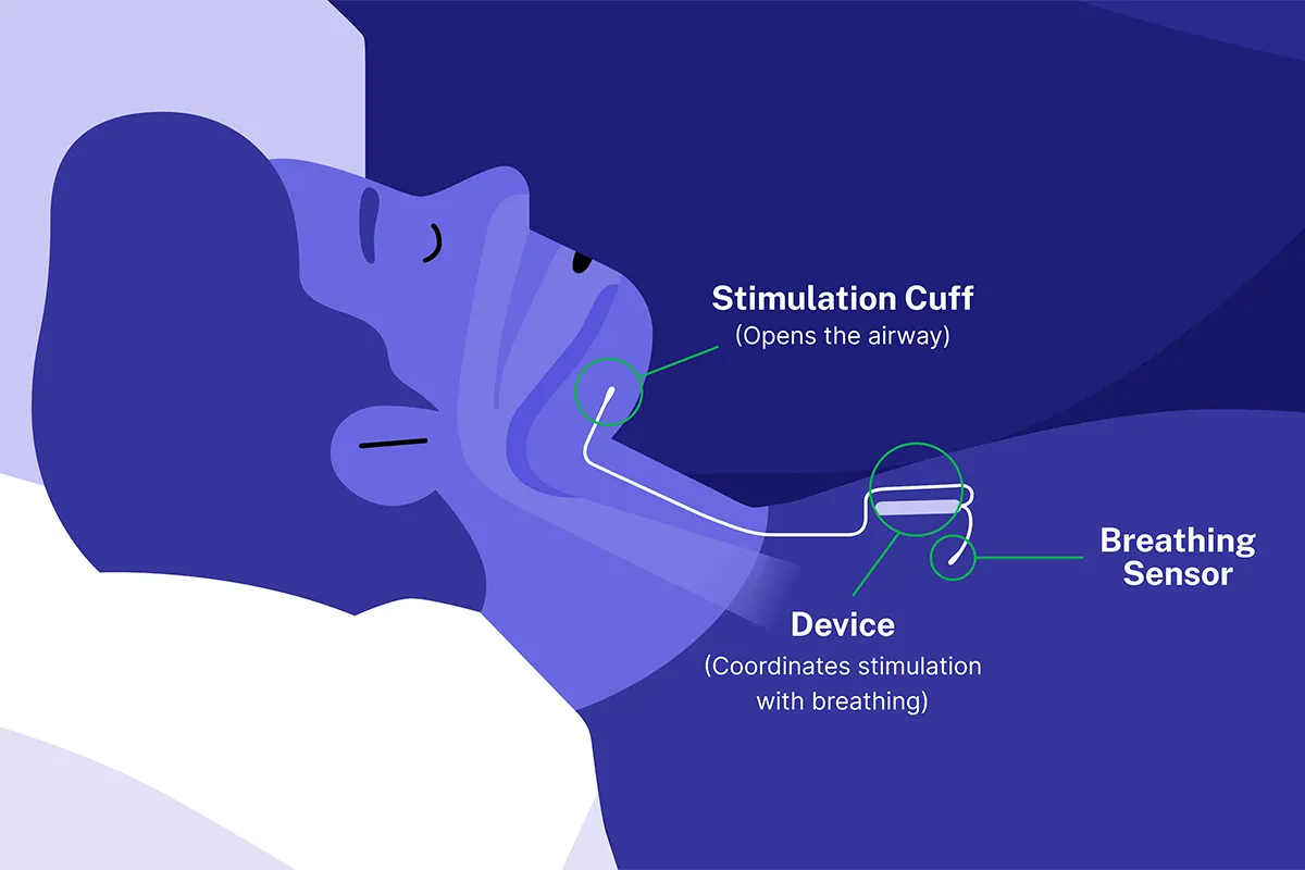 Thinking Of Inspire Surgery For Sleep Apnea thinking-of-inspire-surgery-for-sleep-apnea